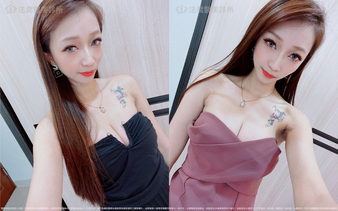法喬醫美診所,邱浚彥,魔滴隆乳,隆乳推薦