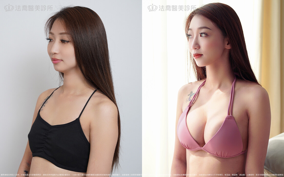 法喬醫美診所,邱浚彥,魔滴隆乳,隆乳推薦