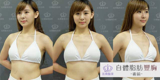 法喬醫美診所-自體脂肪豐胸