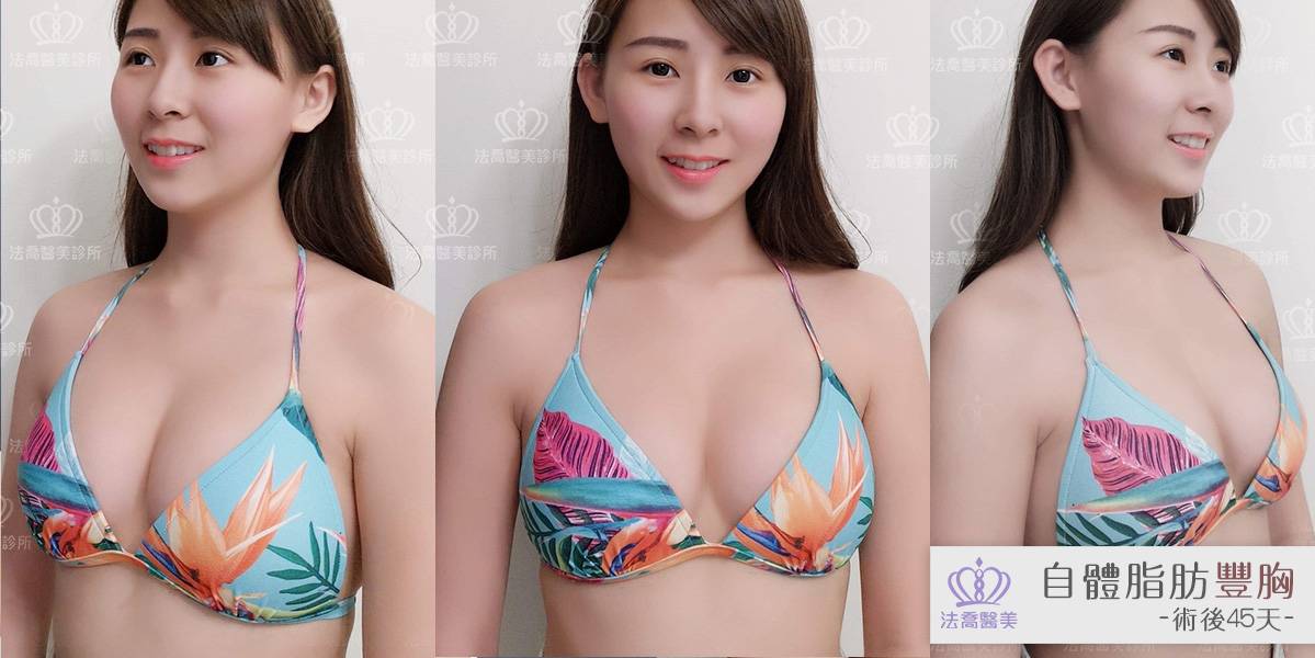 法喬醫美診所-自體脂肪豐胸