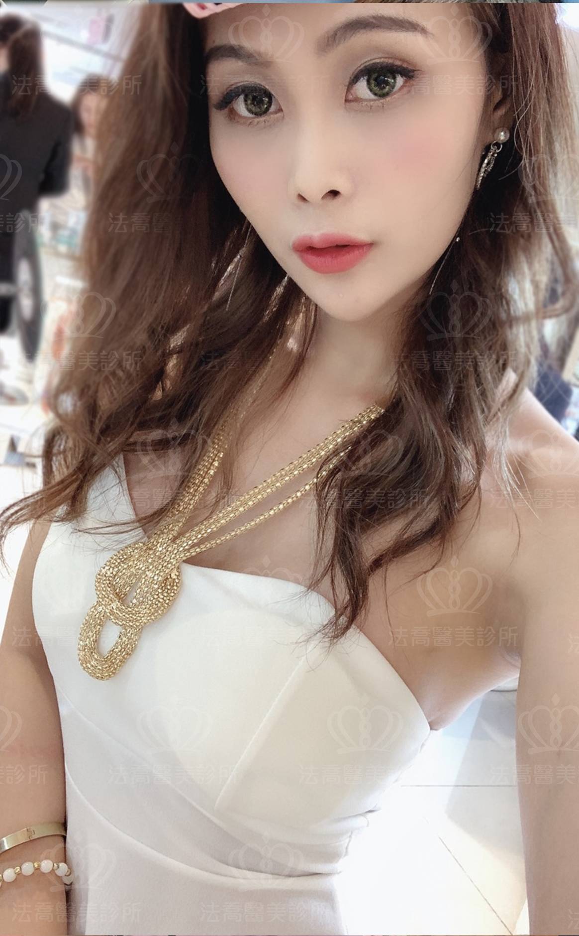 法喬醫美診所_複合式隆乳
