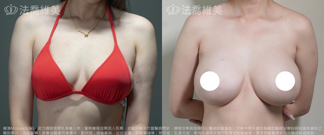 法喬醫美診所,邱浚彥,魔滴隆乳,隆乳推薦