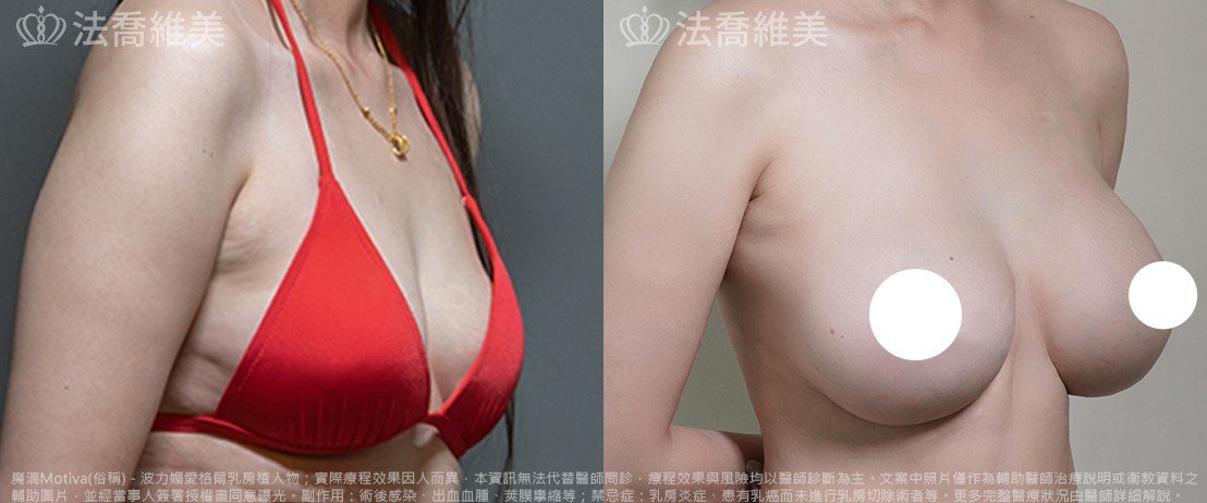 法喬醫美診所,邱浚彥,魔滴隆乳,隆乳推薦
