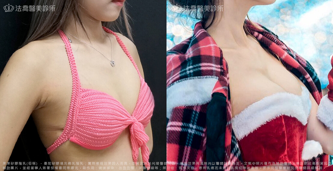 法喬醫美診所,邱浚彥,隆乳推薦