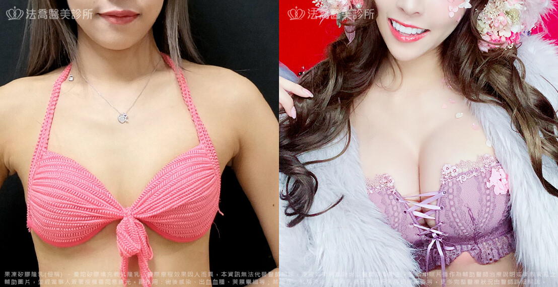 法喬醫美診所,邱浚彥,隆乳推薦