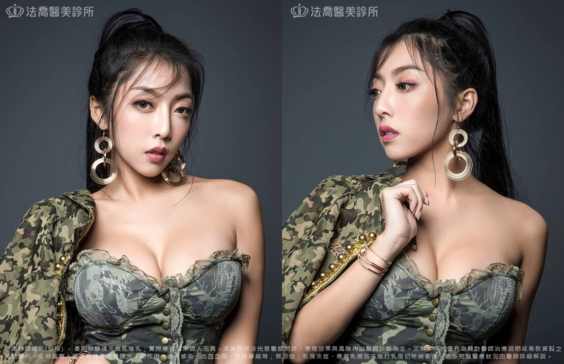 法喬醫美診所,邱浚彥,隆乳推薦