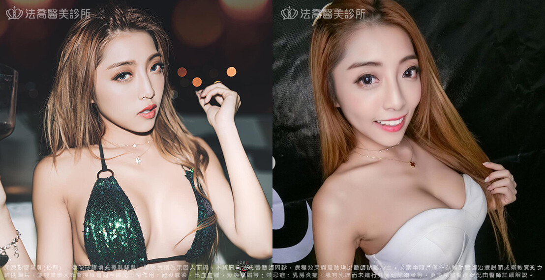 法喬醫美診所,邱浚彥,隆乳推薦