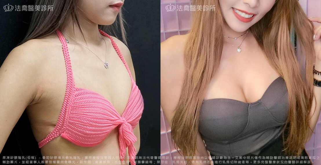 法喬醫美診所,邱浚彥,隆乳推薦