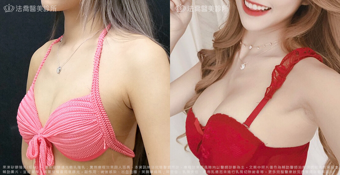 法喬醫美診所,邱浚彥,隆乳推薦