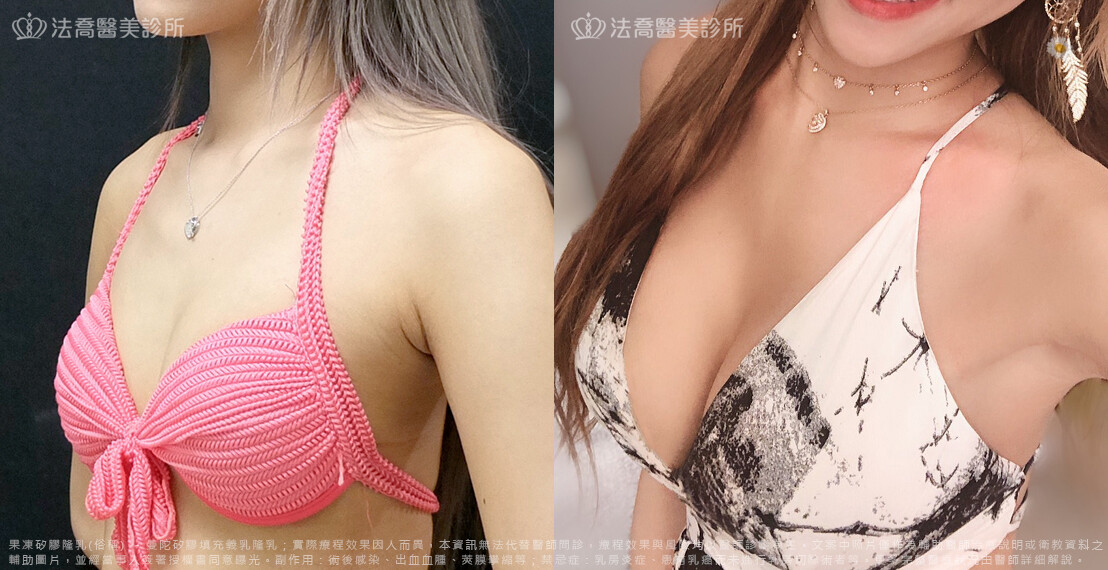 法喬醫美診所,邱浚彥,隆乳推薦