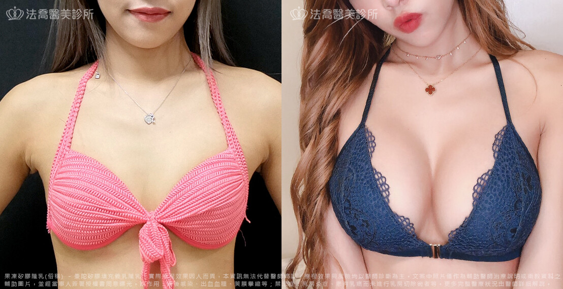 法喬醫美診所,邱浚彥,隆乳推薦