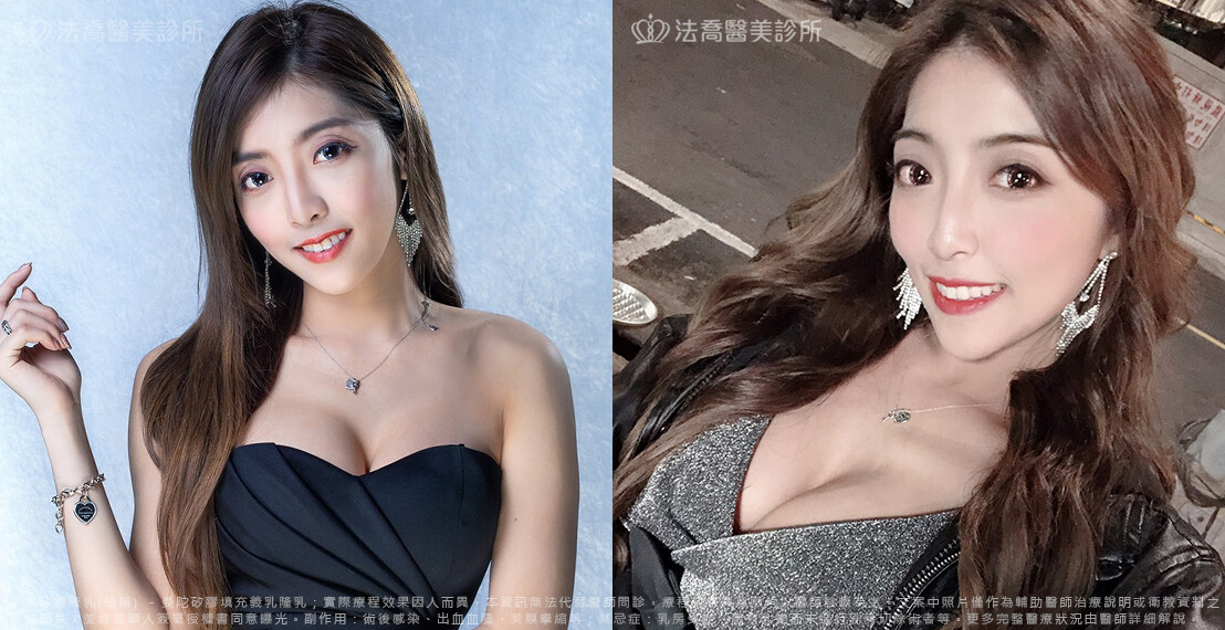 法喬醫美診所,邱浚彥,魔滴隆乳,隆乳推薦