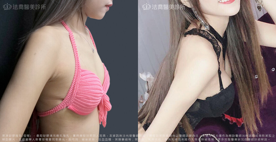 法喬醫美診所,邱浚彥,隆乳推薦