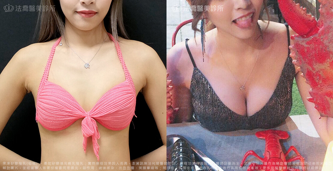 法喬醫美診所,邱浚彥,隆乳推薦