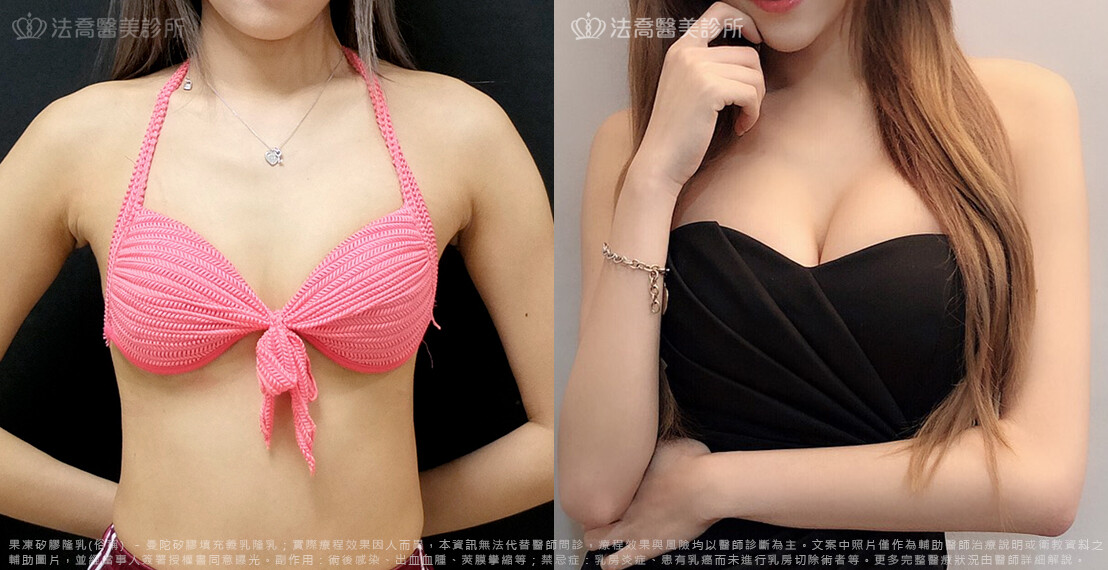 法喬醫美診所,邱浚彥,隆乳推薦