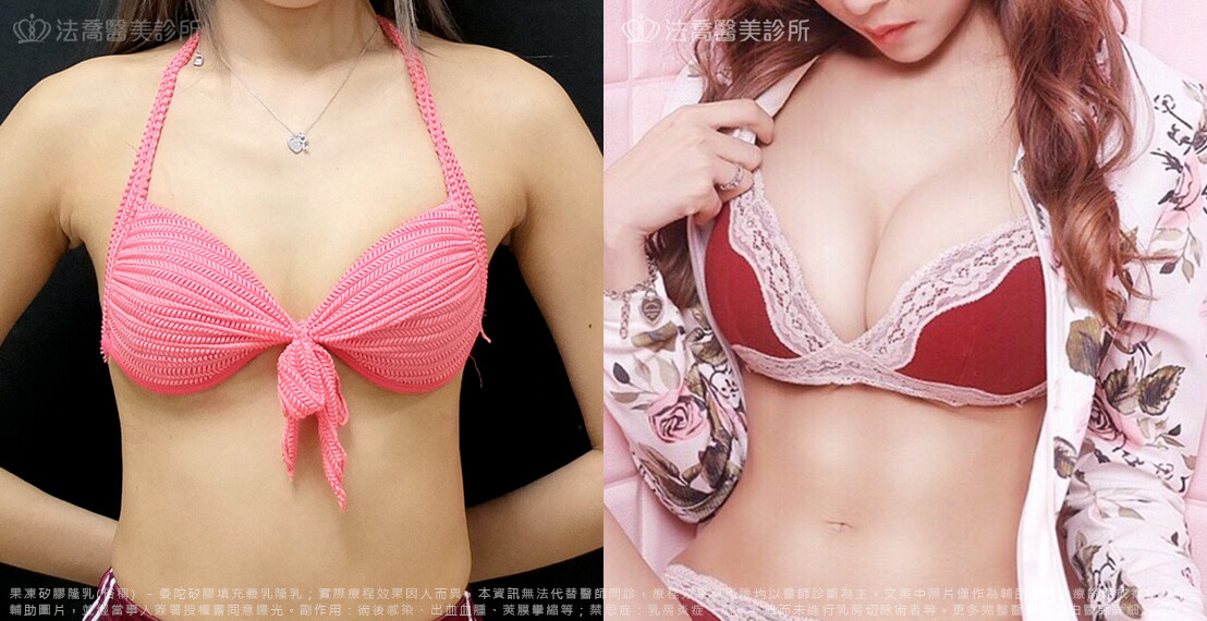 法喬醫美診所,邱浚彥,隆乳推薦