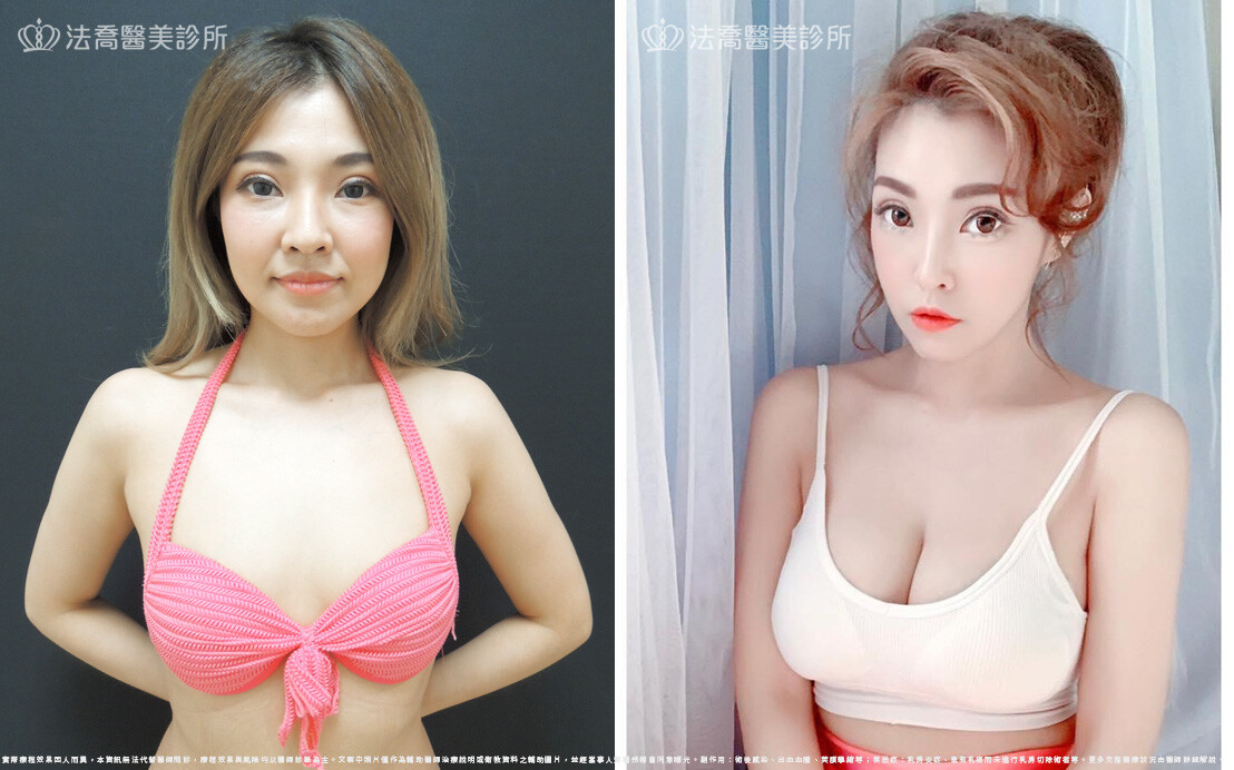 水滴型果凍矽膠隆乳