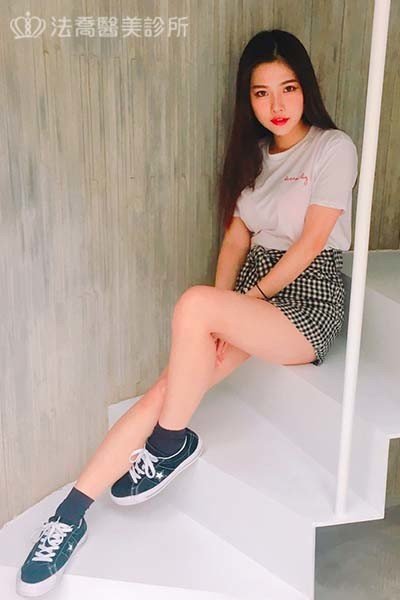 自體肋骨隆鼻