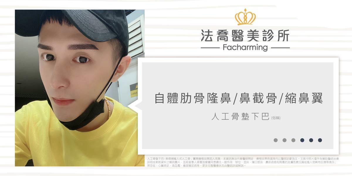法喬醫美診所,邱浚彥,自體肋骨隆鼻,隆鼻推薦
