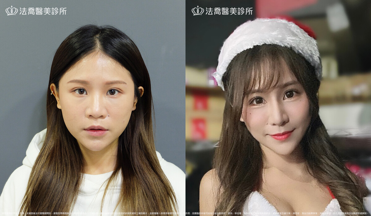 法喬醫美診所,邱浚彥,自體肋骨隆鼻