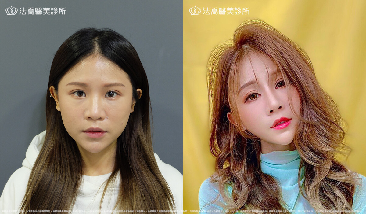 法喬醫美診所,邱浚彥,自體肋骨隆鼻