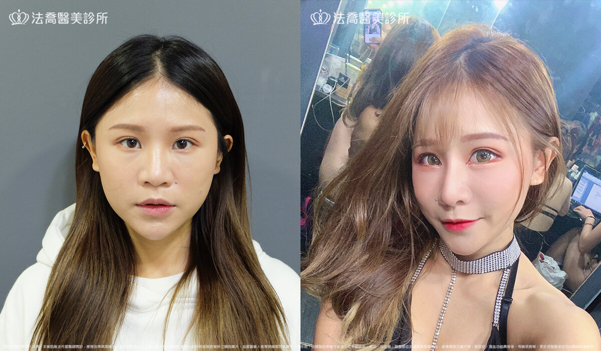 法喬醫美診所,邱浚彥,自體肋骨隆鼻