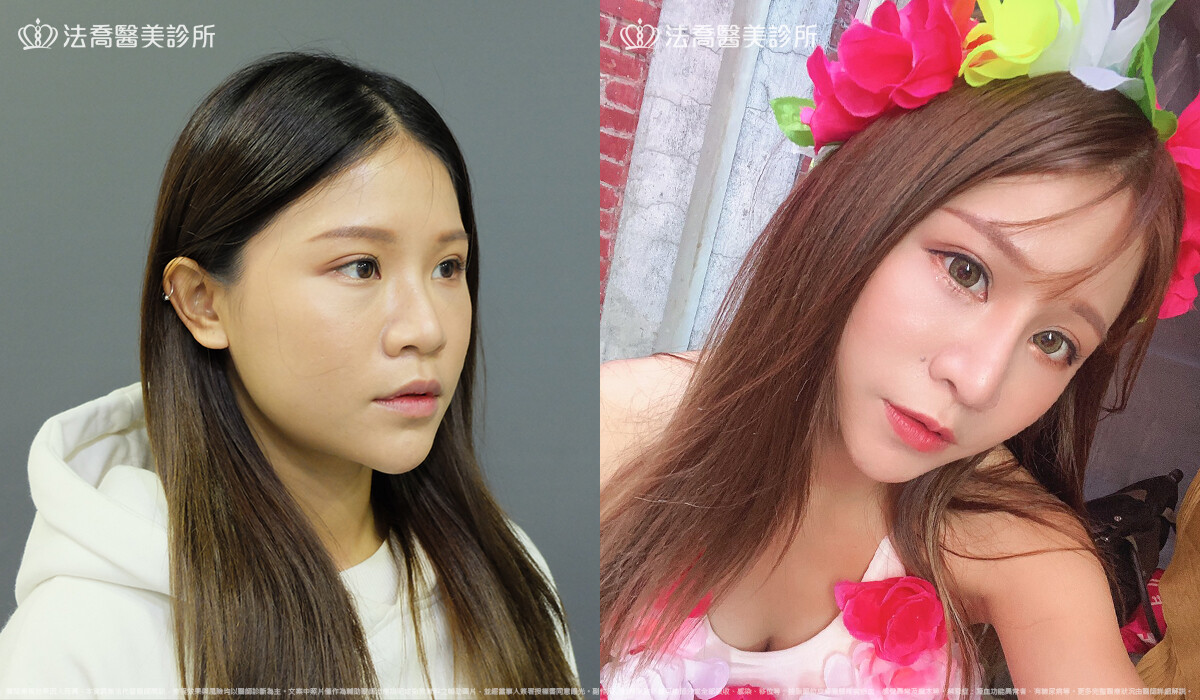 法喬醫美診所,邱浚彥,自體肋骨隆鼻