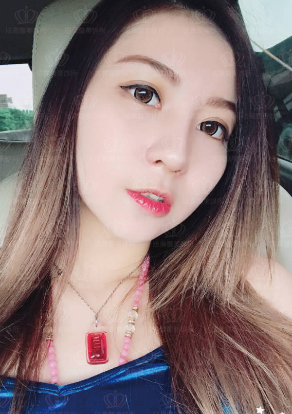 自體肋骨隆鼻