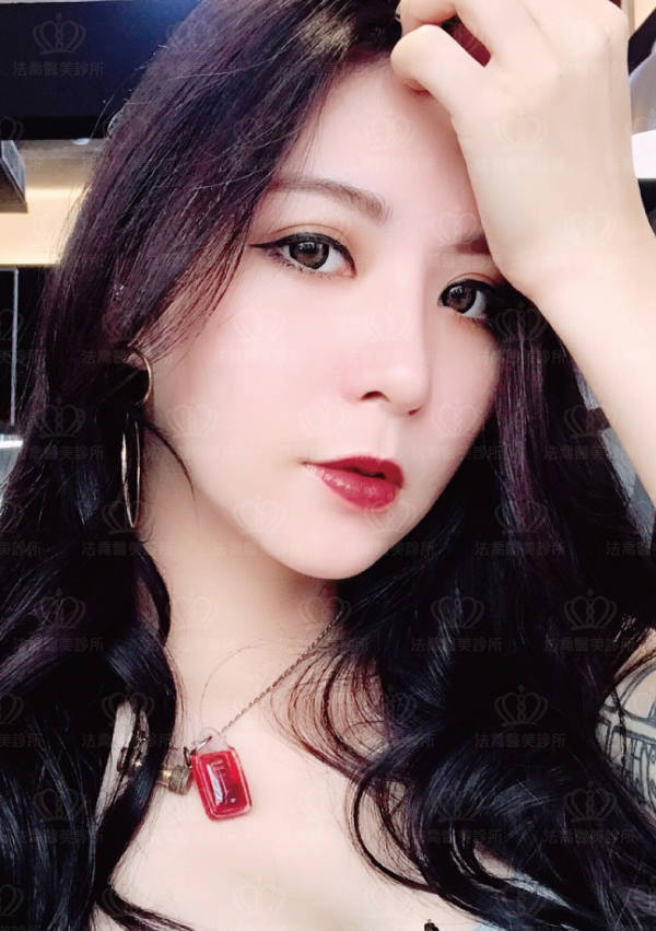 自體肋骨隆鼻
