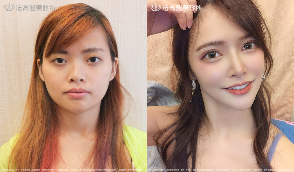 法喬醫美診所,邱浚彥,自體肋骨隆鼻