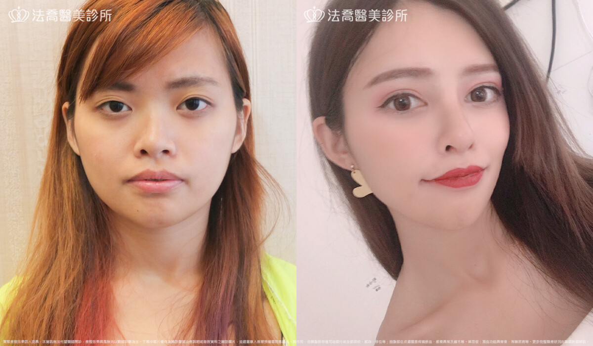 法喬醫美診所,邱浚彥,自體肋骨隆鼻