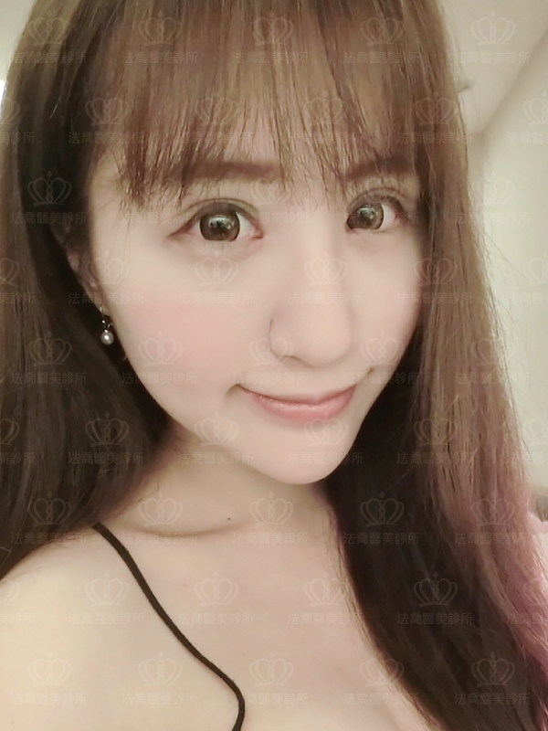 法喬醫美診所自體肋骨隆鼻術後15天BA圖