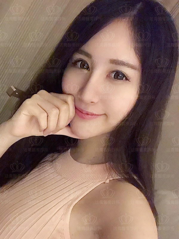 法喬醫美診所自體肋骨隆鼻術後三個月BA圖