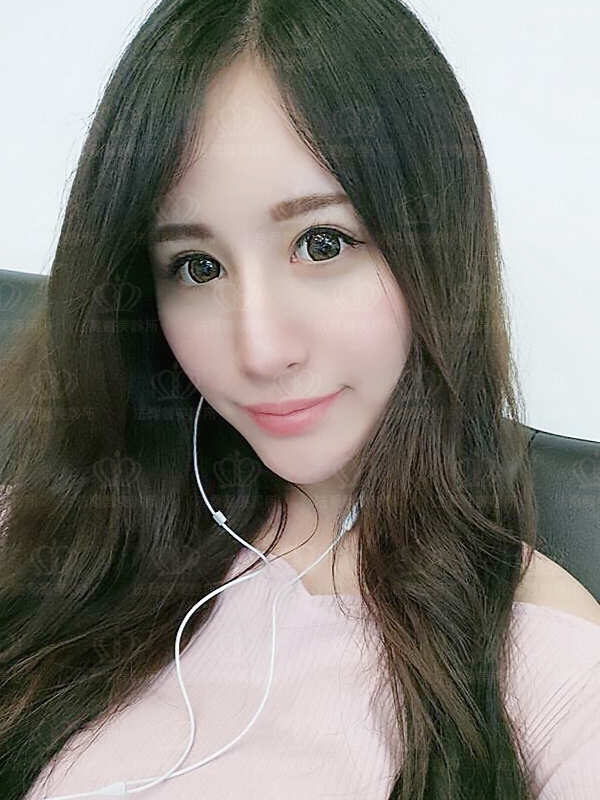 法喬醫美診所自體肋骨隆鼻術後六個月BA圖