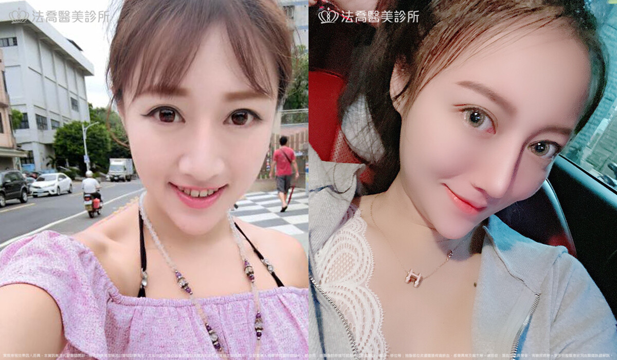 法喬醫美診所,邱浚彥,自體肋骨隆鼻