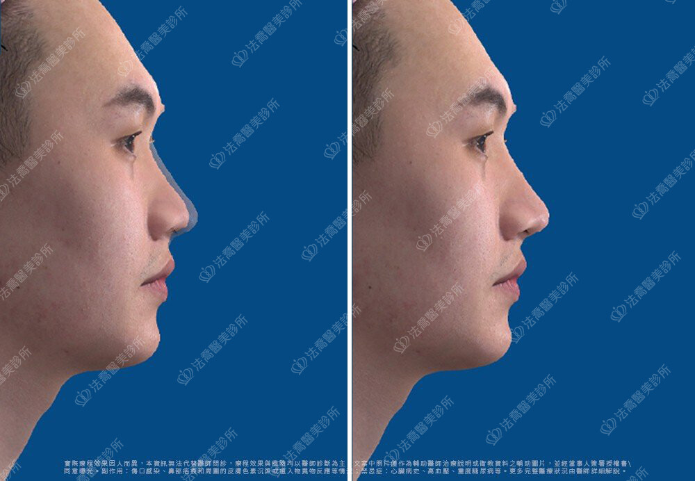 徐謙隆鼻術前3D模擬