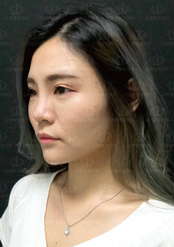 自體肋骨隆鼻