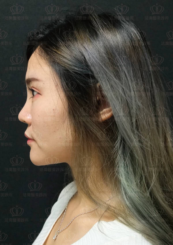 自體肋骨隆鼻