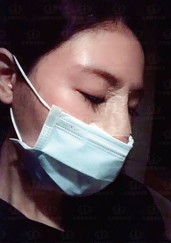自體肋骨隆鼻