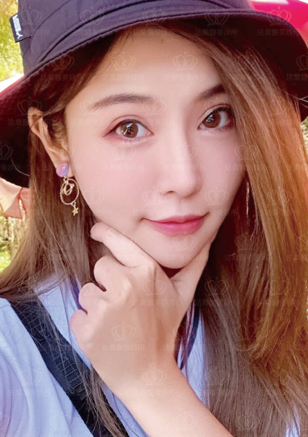 自體肋骨隆鼻