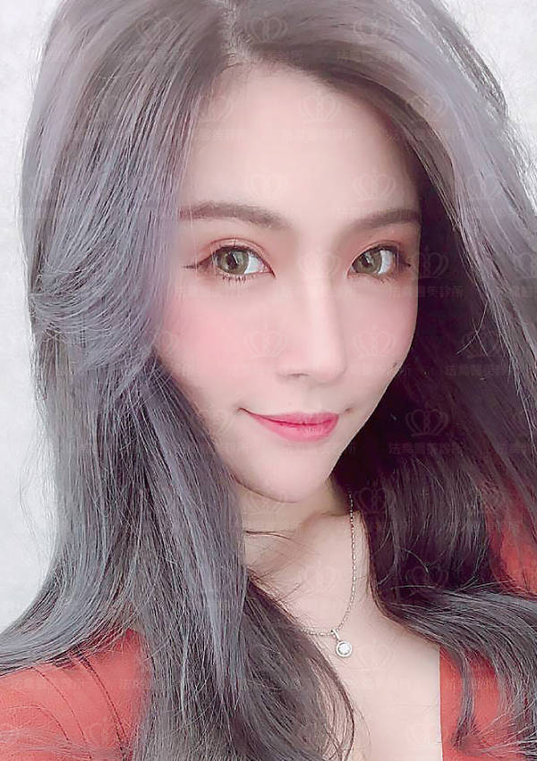 自體肋骨隆鼻