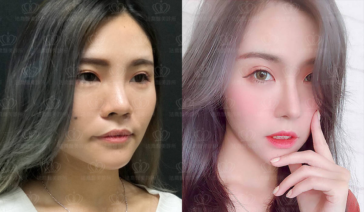 自體肋骨隆鼻