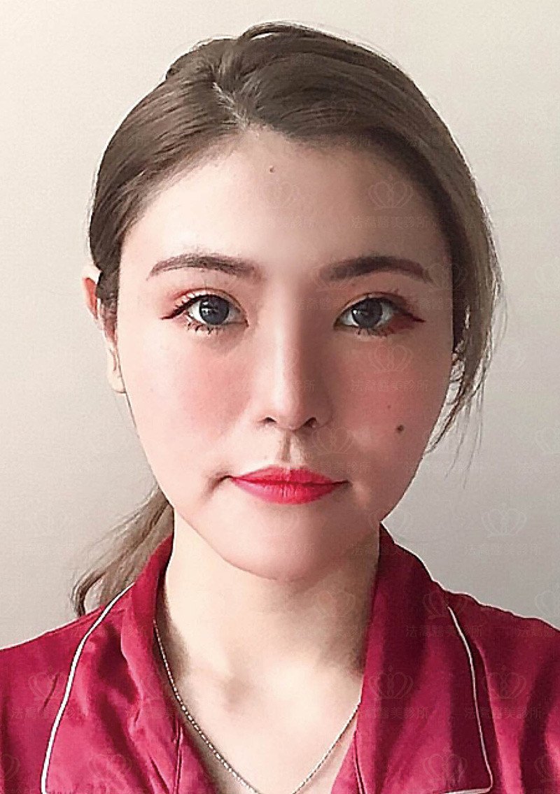 自體肋骨隆鼻