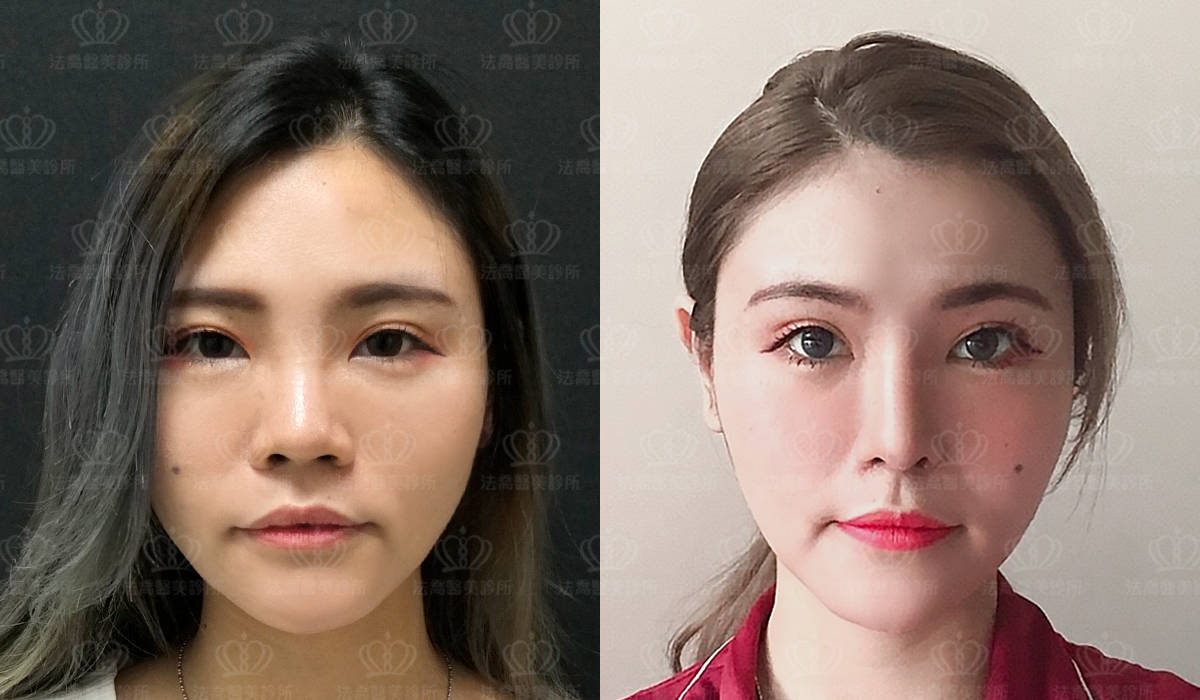 自體肋骨隆鼻