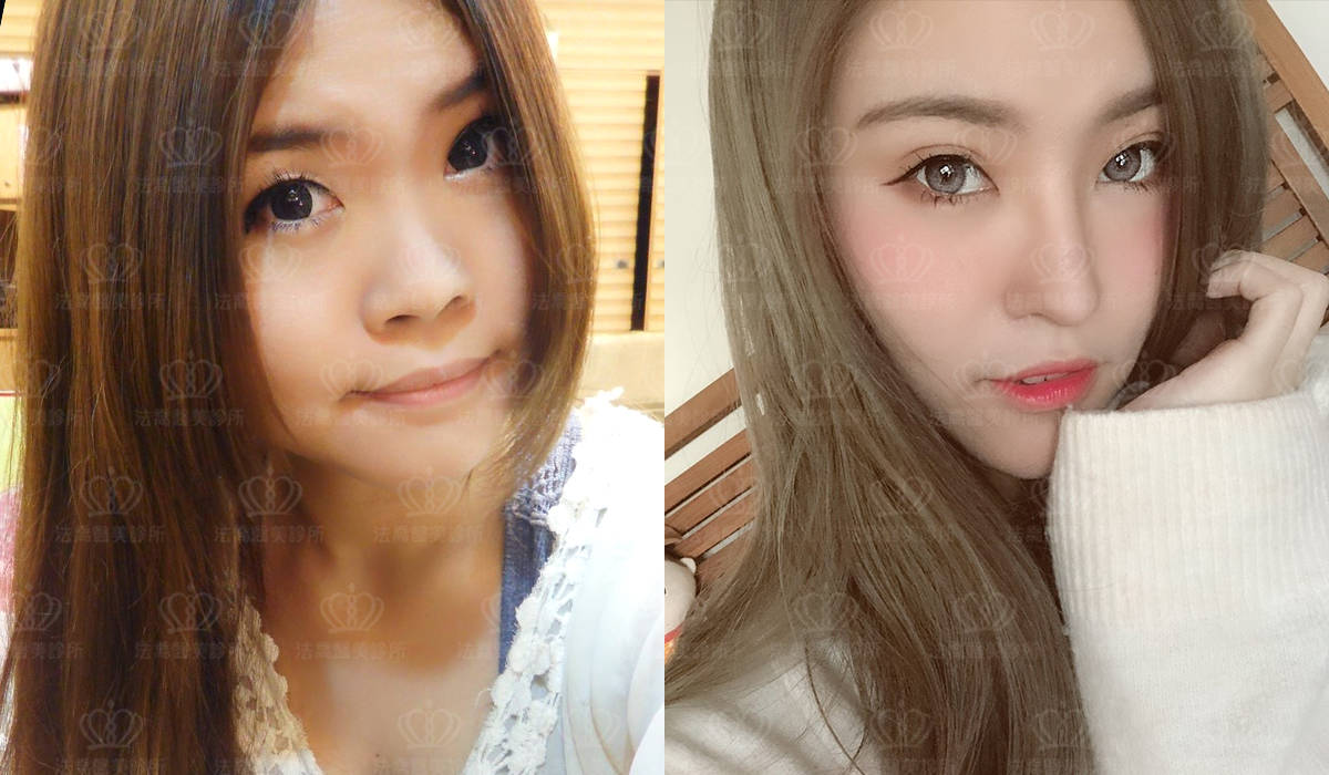 自體肋骨隆鼻