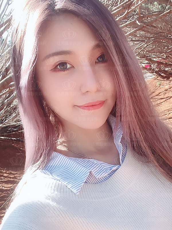 自體肋骨隆鼻