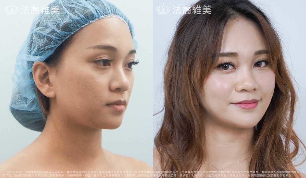 高雄法喬醫美,邱浚彥,威塑抽脂,自體脂肪豐臉