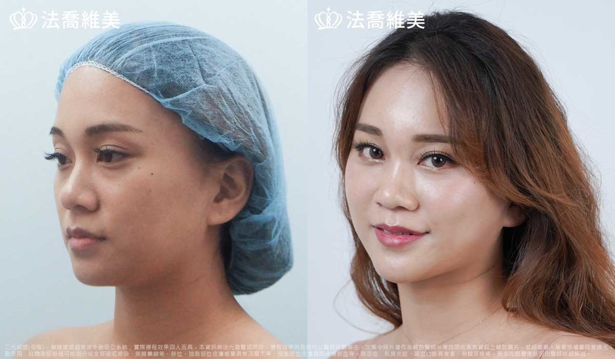 高雄法喬醫美,邱浚彥,威塑抽脂,自體脂肪豐臉