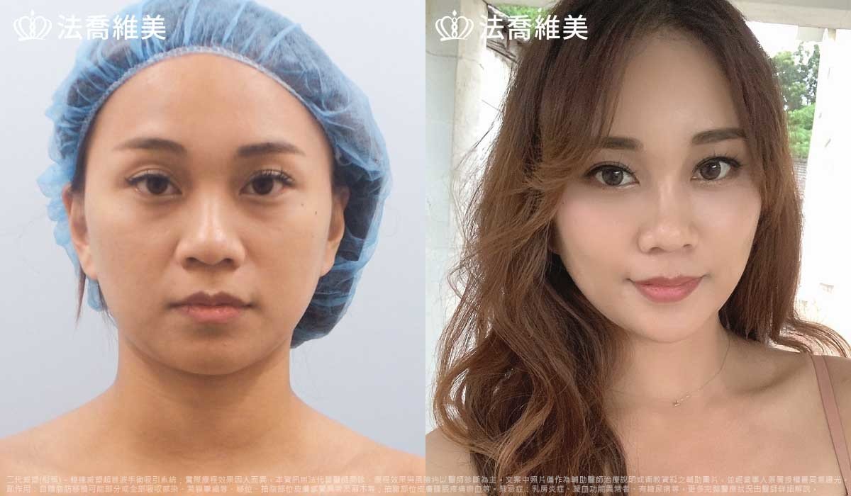 高雄法喬醫美,邱浚彥,威塑抽脂,自體脂肪豐臉