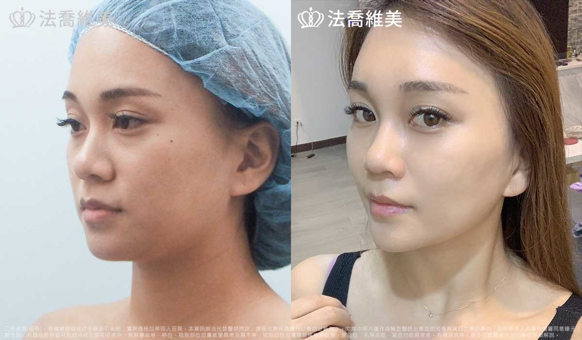 高雄法喬醫美,邱浚彥,威塑抽脂,自體脂肪豐臉